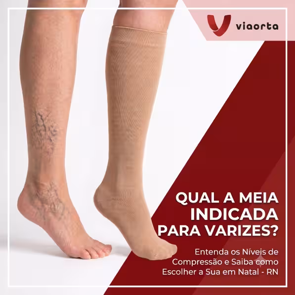 Qual a meia indicada para quem tem varizes? Saiba como escolher em Natal - RN